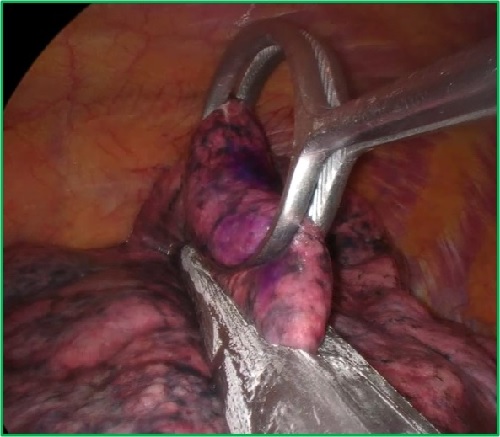 図2 肺腫瘍に対する単孔式胸腔鏡下肺楔状切除術