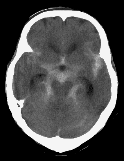 くも膜下出血のCT