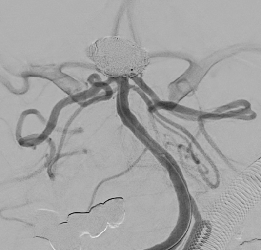コイル塞栓術後