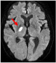 MRI;拡散強調画像